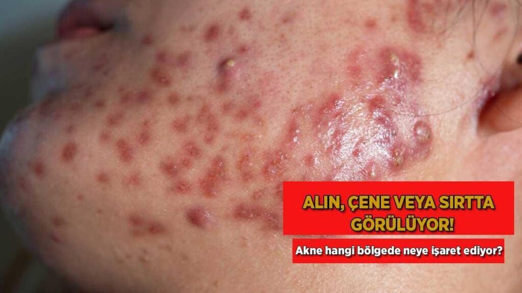 Alın, çene yahut sırtta görülüyor! Akne hangi bölgede neye işaret ediyor?