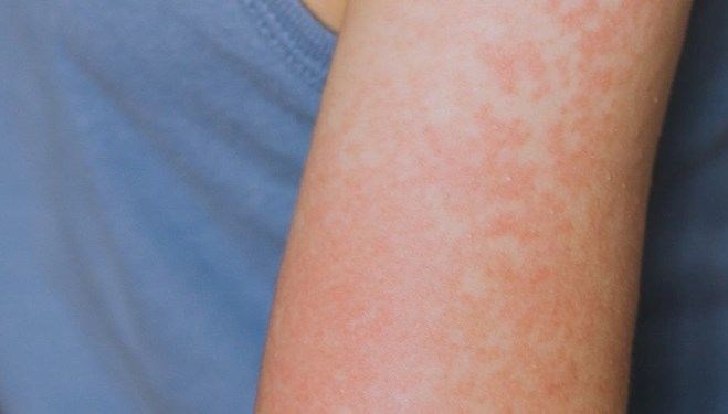 Birinci mevt gerçekleşti: Teksas’ta kızamık salgını