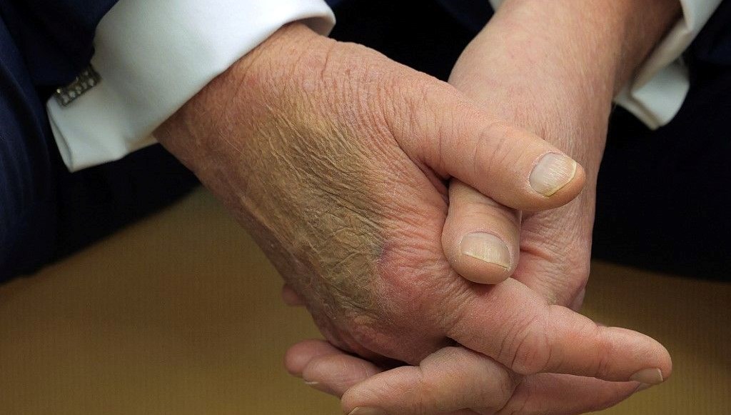 Trump’ın elleri gündemde: Toplumsal medyada morluk tartışması
