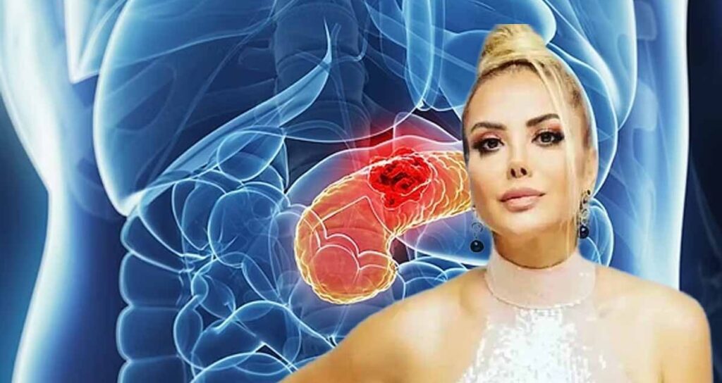 Pankreas kanserinin belirtileri nelerdir, Tanyeli nasıl öğrendi? İşte 2. 3. 4. evre pankreas kanseri belirtileri